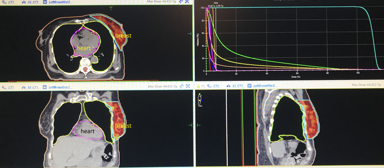 Moderne Bestrahlung bei Krebs der linken Brust