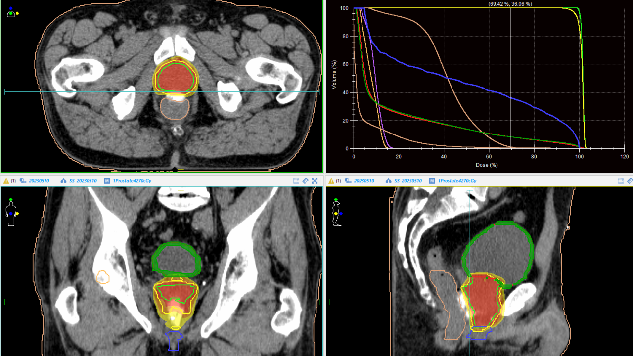 Die Zukunft der Bestrahlung bei Prostatakrebs